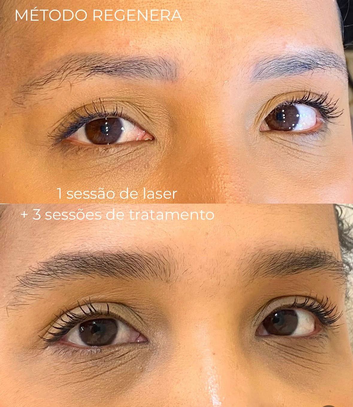 Antes e depois — 1 sessão de laser + 3 sessões de tratamento