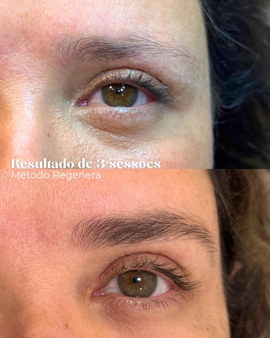 Antes e depois — Resultado em 3 sessões — Método Regenera